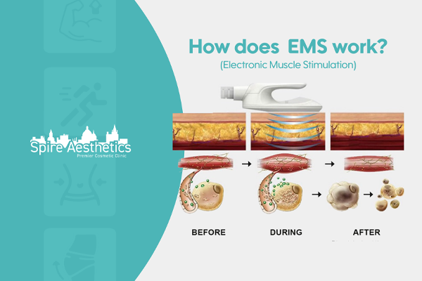 EMS treatment for post pregnancy weight loss treatment Wootton Bassett