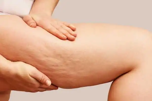 Image of woman showing leg with cellulite Wootton Bassett