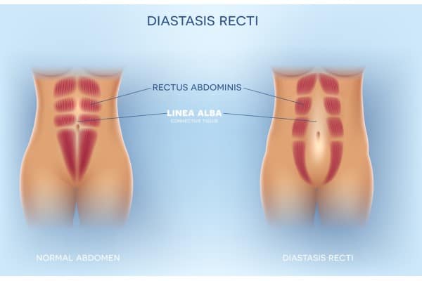 What Non-Surgical Options Are Available for Diastasis Recti Wootton Bassett?
