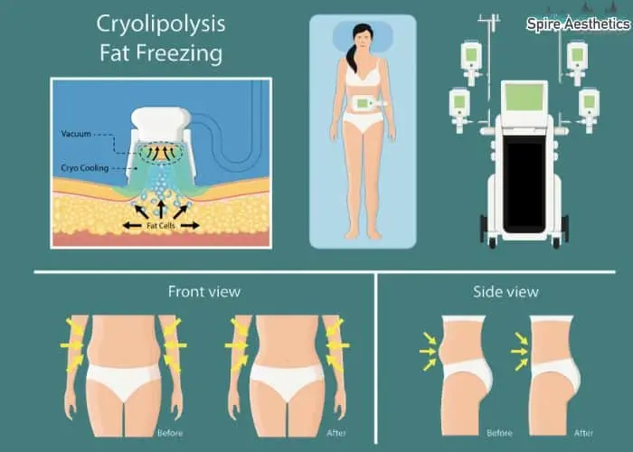 Fat freezing treatment Wootton Bassett benefits for competitions to remove stubborn fat deposits.