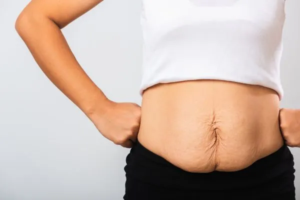 Image of a woman's stomach after weight loss with sagging skin following a gastric band Wootton Bassett