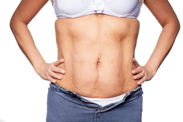 sagging skin on woman's stomach after weight loss injections Wootton Bassett