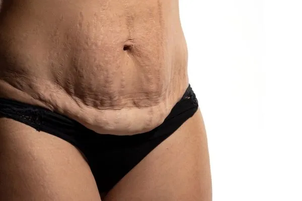 Image of womans stomach after weight loss injections Wootton Bassett showing saggy skin