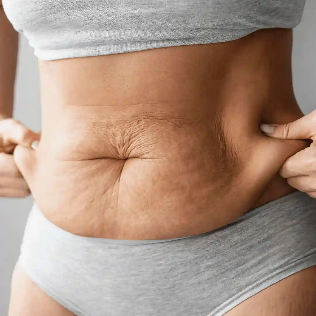 Is It Normal to Have Loose Skin After Pregnancy Wootton Bassett?