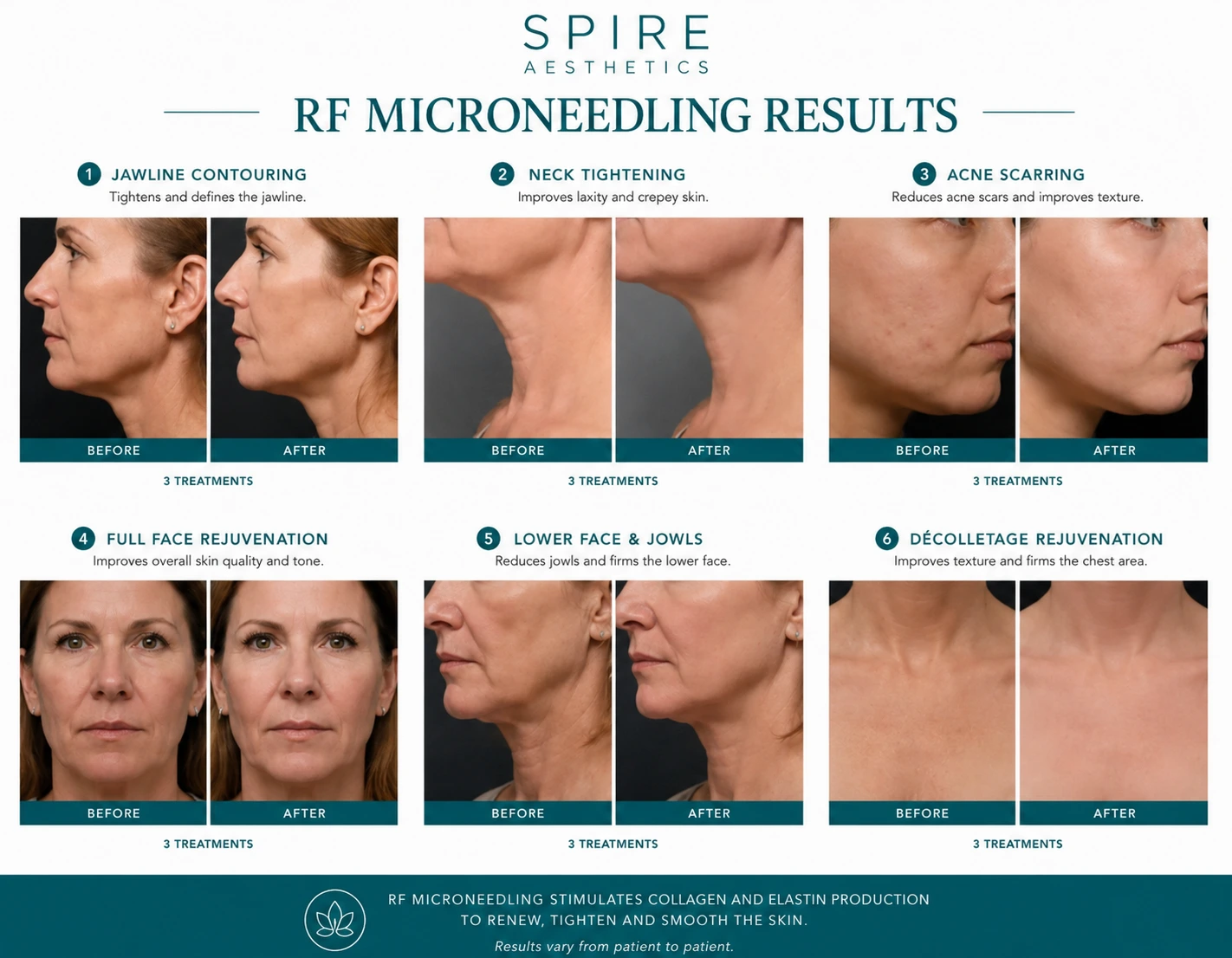 RF Microneedling Skin tightening Wootton Bassett results