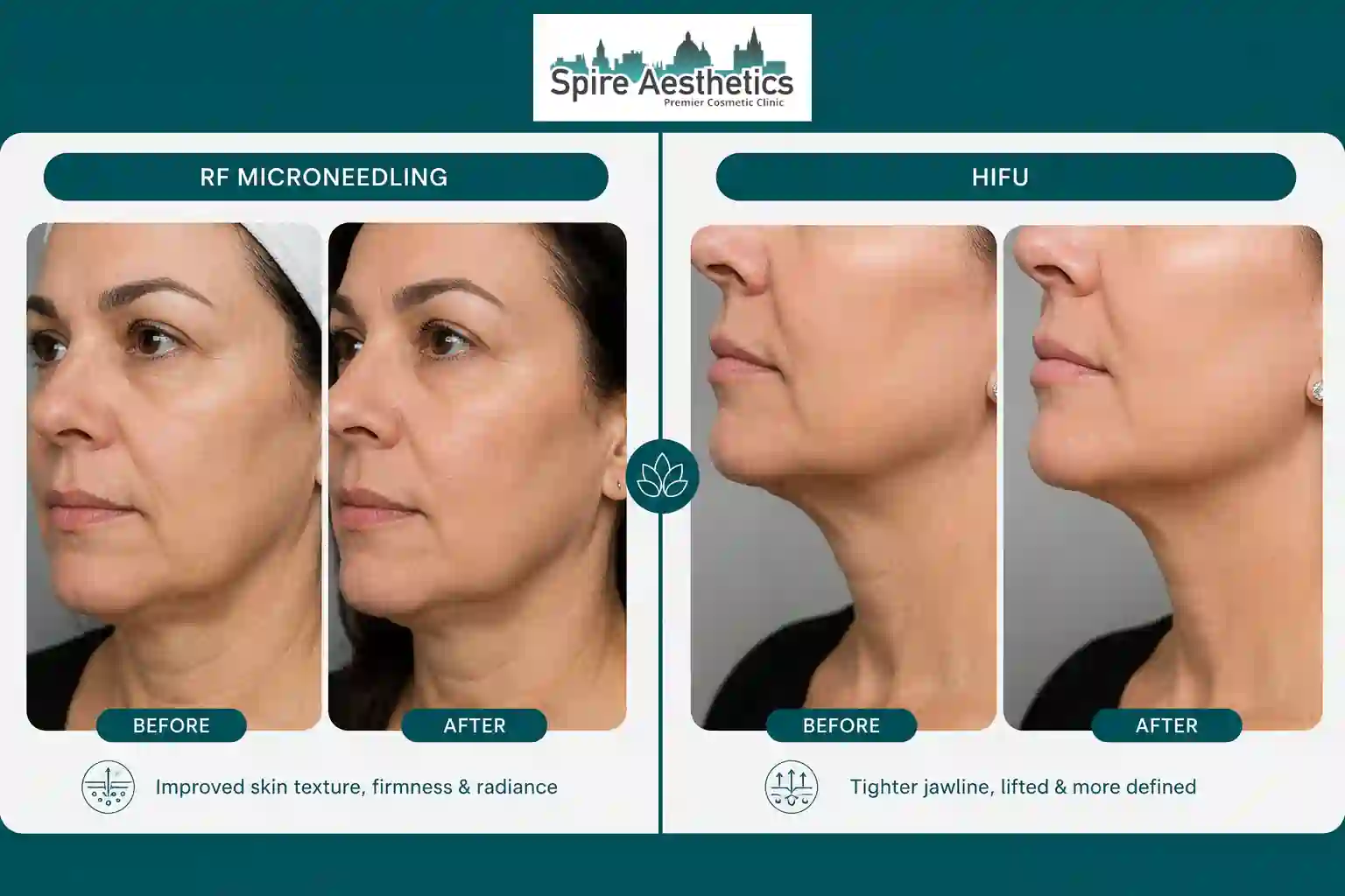 Can RF Microneedling and HIFU Be Combined Wootton Bassett?