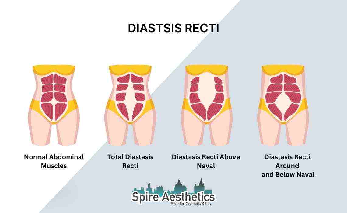 Is Non-Surgical Diastasis Recti Treatment Right for You? Common Concerns Answered Wootton Bassett